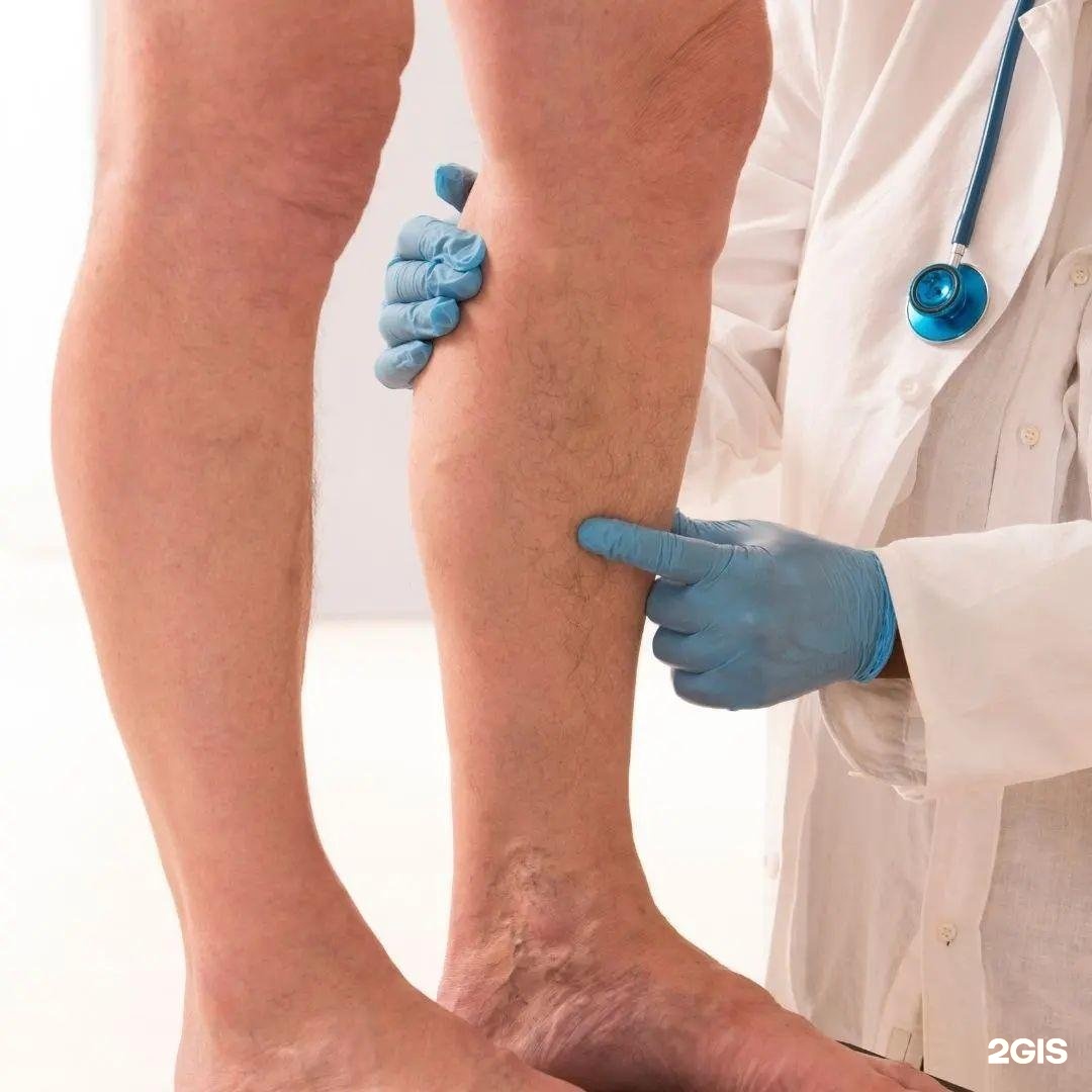 Врач по поводу ног. Флеботромбоз голени клиника. Фолликулярный варикоз. Варикозное расширение вен. Варикозное расширение ног.